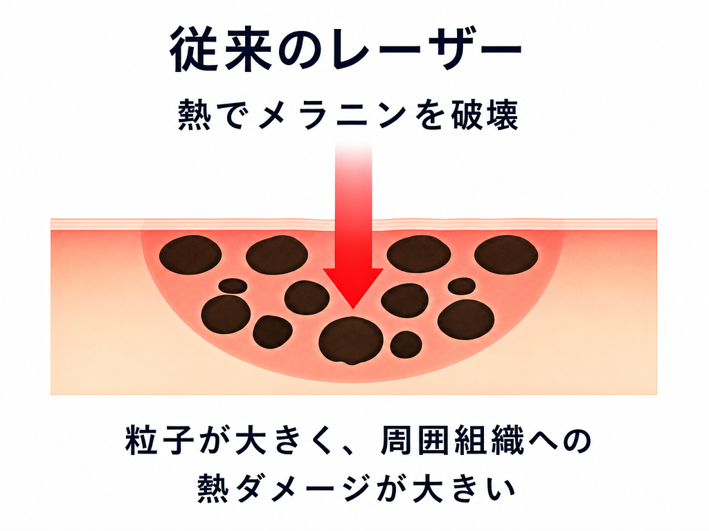 従来のレーザー（イメージ）
