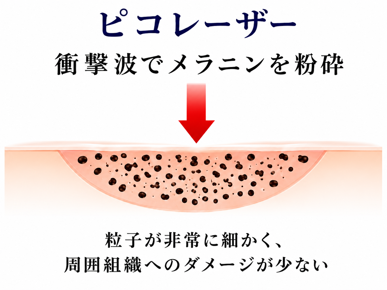 ピコレーザー（イメージ）
