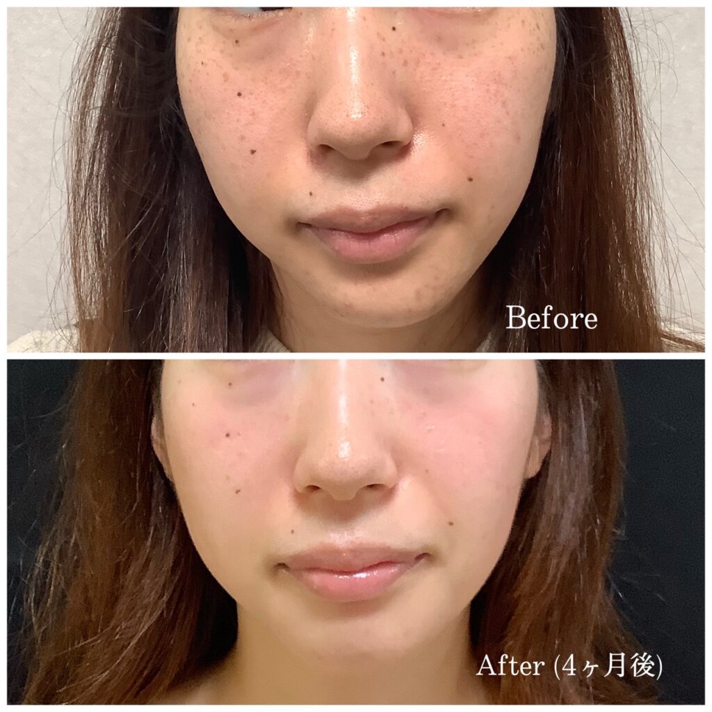 ピコスポット&セラピューティック4ヶ月後